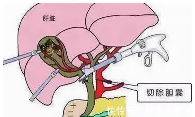 胆囊息肉|胆囊息肉你知多少?这时候了解,还不算晚