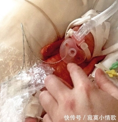 梅茜|婴儿出生后不足一斤,结果让父母泪流满面!