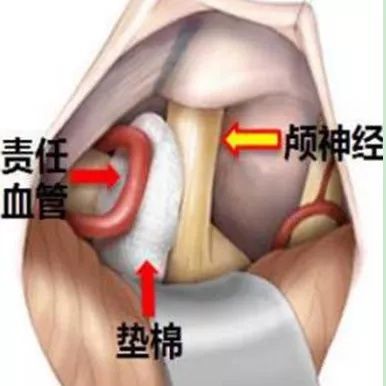 神经损伤|不是所有的面部抽动都叫面肌痉挛