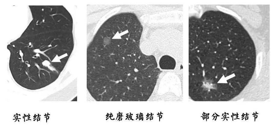 囊肿|结节、息肉、囊肿、增生、肿瘤标志物，到底哪个离癌症更近？