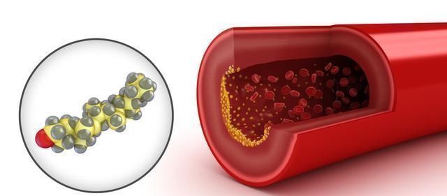 甘油三酯|甘油三酯偏高的人,多用2物泡水喝,有助血管“畅通无阻”