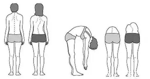 孩子|8岁男孩脊椎侧弯,只因家人常做这个动作,这个错误,90%的父母都在犯