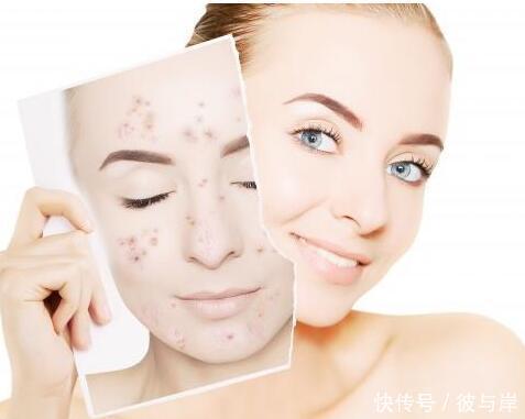祛痘印方法用不对可能伤害皮肤!做到4点,更科学的祛痘印