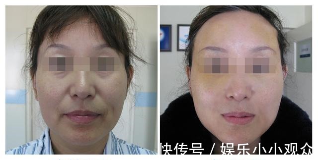 皮肤 46岁做拉皮手术是种什么体验,分享一下我的真实经历!
