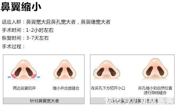 科普 鼻翼变窄整形手术如何做?多少钱?科普&价格,分享塑造美鼻的秘密!