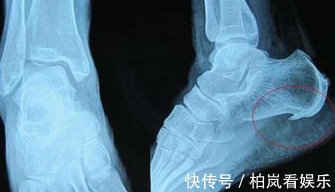 骨刺|5种病无法根治!忽悠能根治是骗你,莫轻信谣言,搞得人财两空!