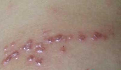 毒素|带状疱疹又名蛇缠腰,喝下这杯药草茶,赶走毒素,疱疹让道很简单