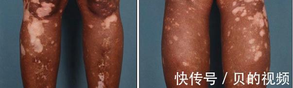 打虫药|孩子脸上有白斑,要打虫吗?听听儿科医生怎么说