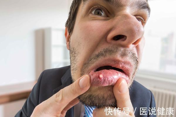 癌细胞|口腔癌发生时,身体或有6种表现,发现后,及时检查,别轻视