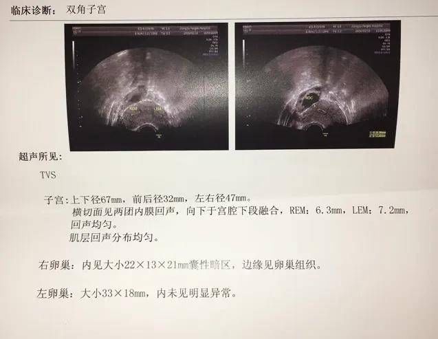 病因|怀孕总是留不住，竟因“房子”长得和别人不一样