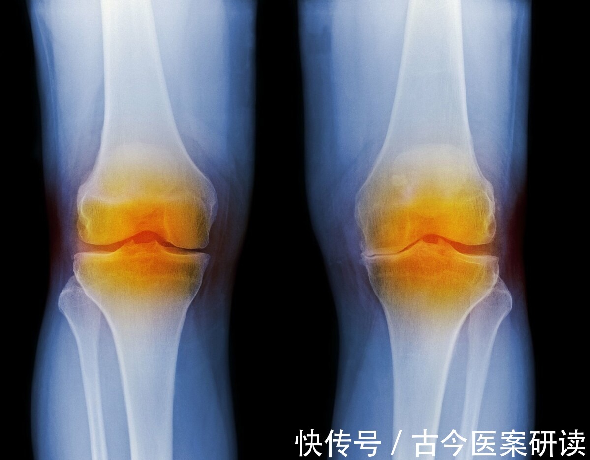 增生|七十岁老太太,右边膝盖痛1周,无法走路,医生:同种病也有轻重