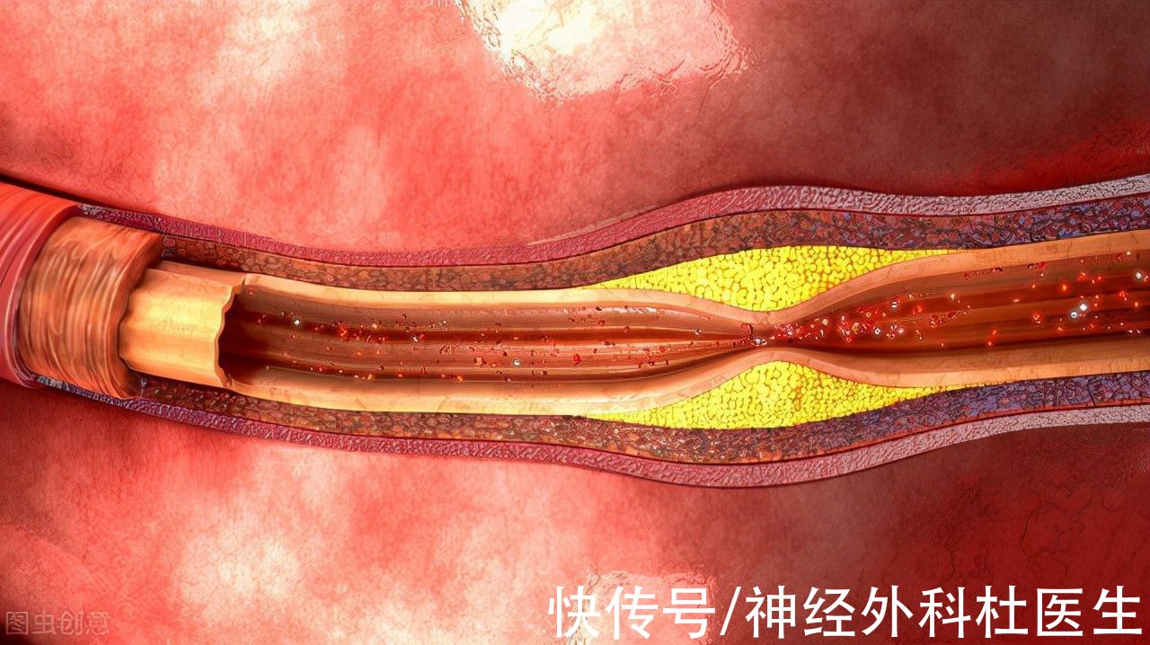 甘油三酯|血脂高的人，身体会有3种“异常”，或在暗示你，血脂已经超标