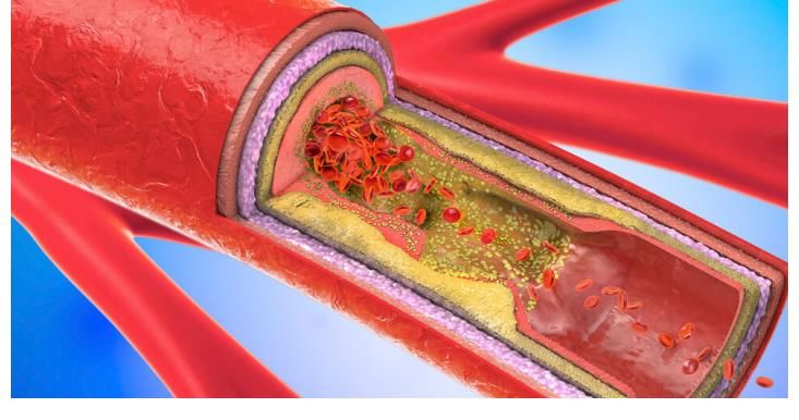 脑出血|35岁男子晨跑猝死，了解病史后，医生叹息：高血压最忌一件事
