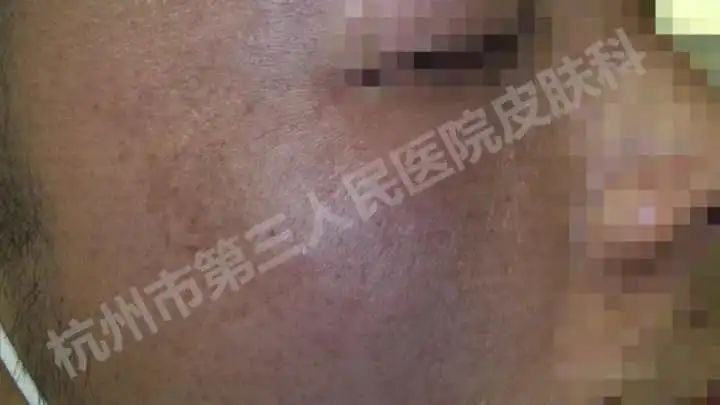 “我竟有黄褐斑？”拿到报告单后，年轻小伙愣在原地：这不是女人才长的吗？