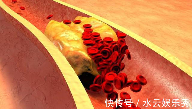 肌肉毒性|他汀会增加肝损害、糖尿病、肌肉毒性的副作用!医生说这样选择!