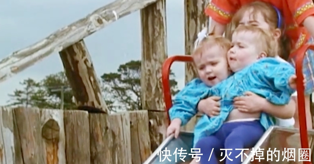 索菲亚|2女孩共用一个躯体生活3年,要将她们个体分离,能成功吗?