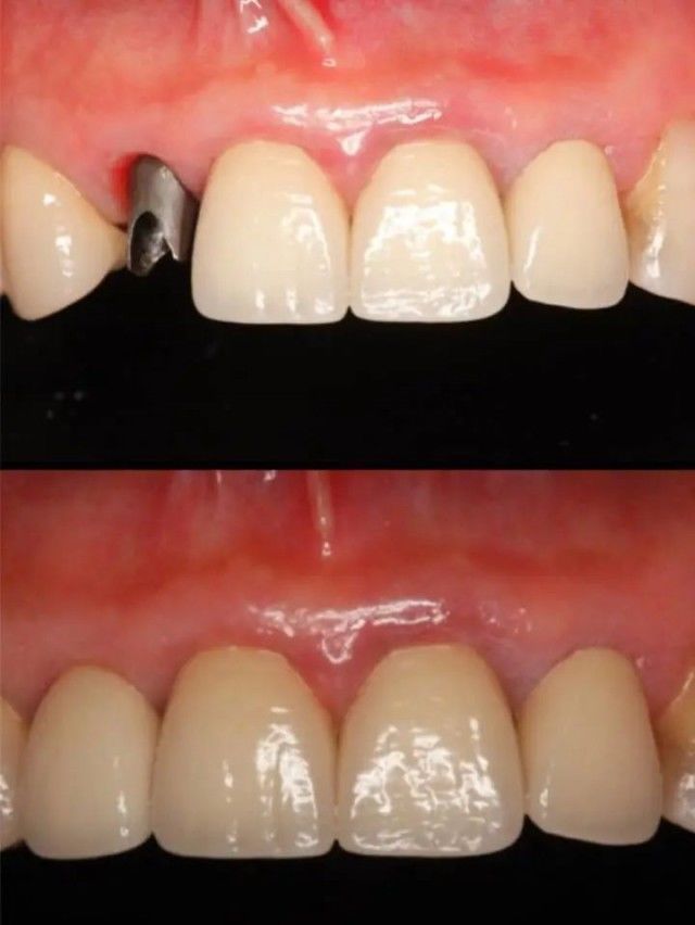 小伙|“我才30多岁啊!”杭州小伙张开嘴,医生一句话让他直掉泪:全都保不住了