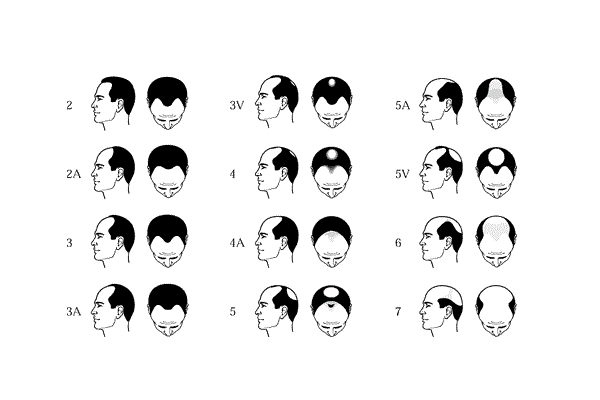 秃头|孩子脱发又秃头，到底是遗传了谁？