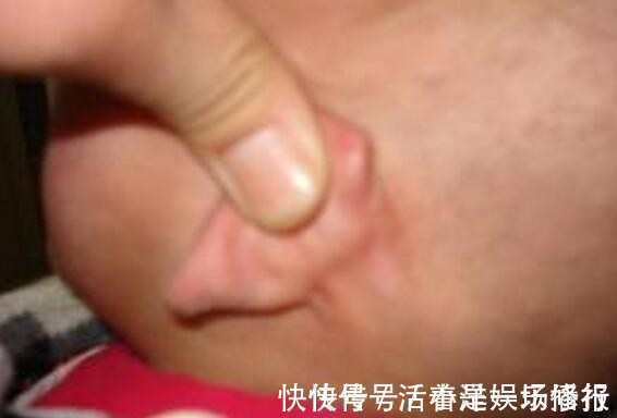 便血|身上出现以下症状是肠癌,却被误认为是痔疮,及早治疗