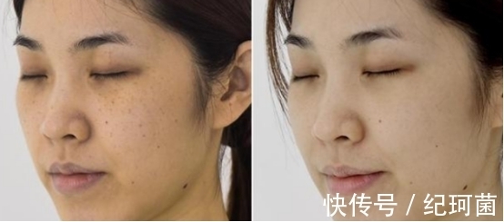 黄褐斑|大牌祛斑产品哪款最有效果?全球公认最好的祛斑产品抢先看~