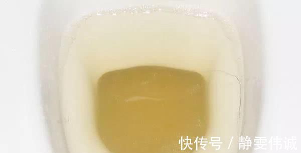 肝細胞|手掌出現的這個紋，居然是肝癌前兆肝臟發出的5個“求救”信號，別知道的太晚