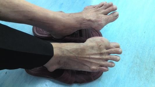 几种治疗痛风的有效偏方，收藏了