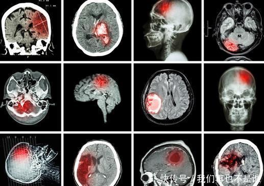 脑梗为何愈来愈多医生别总怪肥肉，3种调料要少