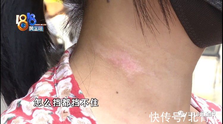 朱老板|姑娘拔火罐，后背起了火
