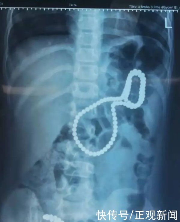 异物|危险！洛阳4岁女童误吞105颗磁力珠致肠道6处穿孔