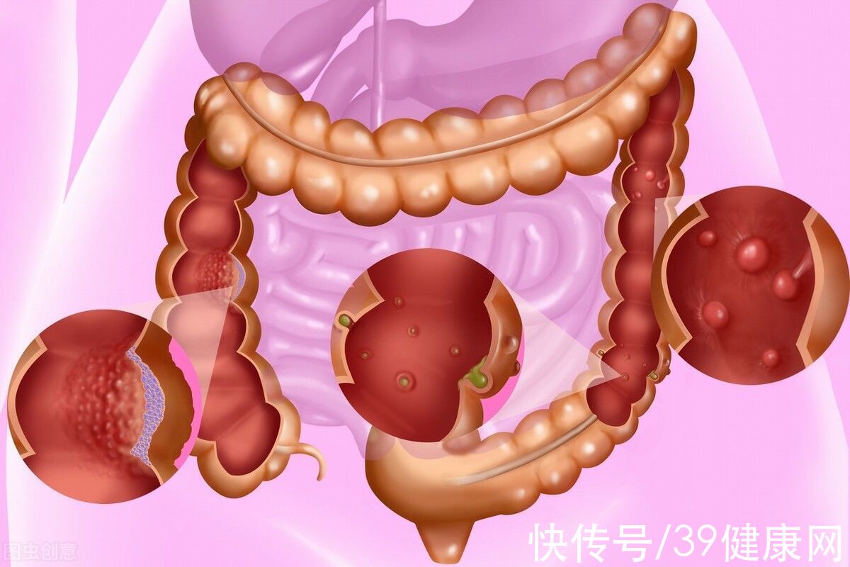 良性|体检查出囊肿、结节、息肉是癌症先兆？要不要切？很多人都搞错了