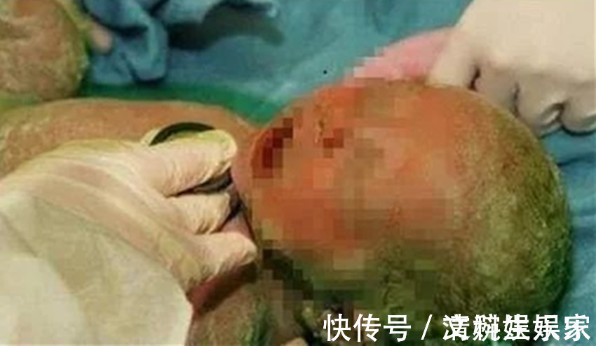 产科医生|90孕妈怀孕35周,被迫剖宫产生下“绿娃娃”,医生怒斥太无知