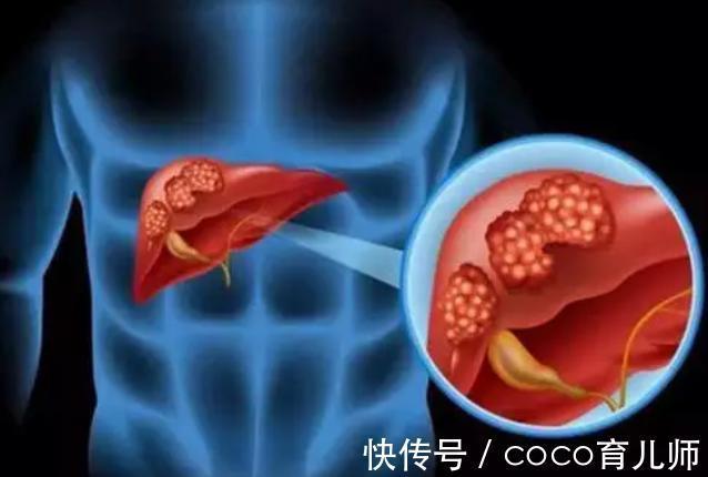 医生|转氨酶升高是肝脏不好吗？医生提醒：几个原因不容忽视