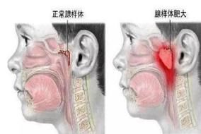 扁桃体肥大|五花八门的“止鼾神器”，真能让人安安静静睡一宿？