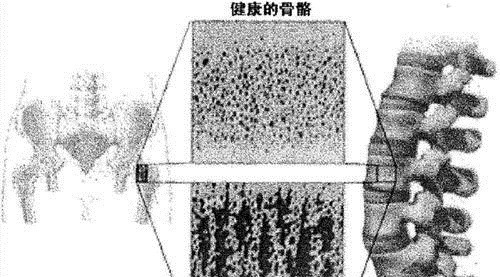 饮食习惯|骨质疏松还在盲目吃钙片先做到这3点,把骨头慢慢“养”好