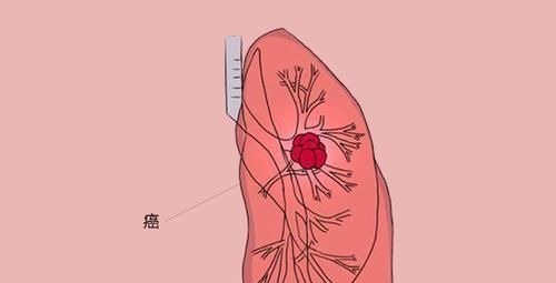 患者|得了肺癌，究竟还能活多久熬过五年生存期，是不是就安全了