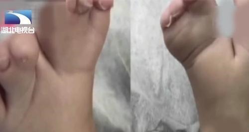 指头|罕见!新生儿有25根指头,一看到妈妈的手,医生瞬间明白了