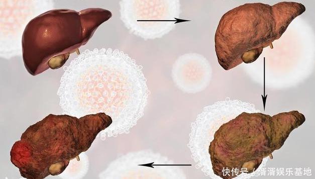 手上出现4个变化,说明肝在求救,多做2事,肝脏不会硬化