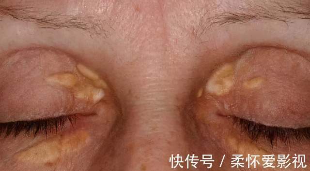 胆固醇|血脂高不高,全写在脸上!脸上出现5个“表现”,请及时调理