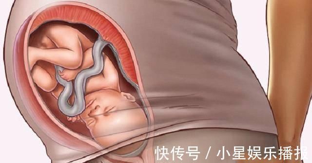 入盆|有一种孕肚,不仅入盆有点困难,孕晚期还需要托腹带,希望你没中