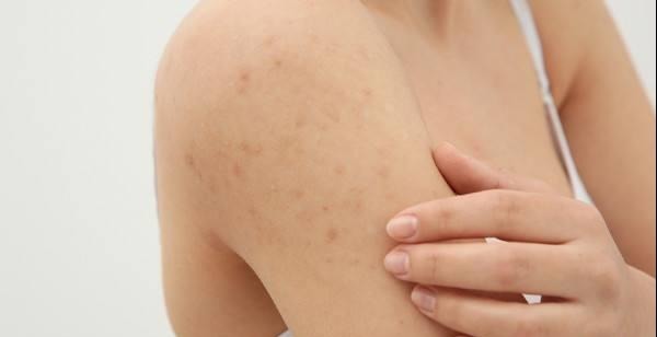 皮肤过敏|皮肤都很脆弱,过敏说来就来,远离它注意以下几点!