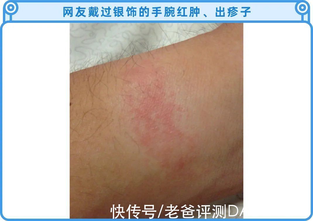 半岛都市报|千万别乱戴银饰，里面的水有点深