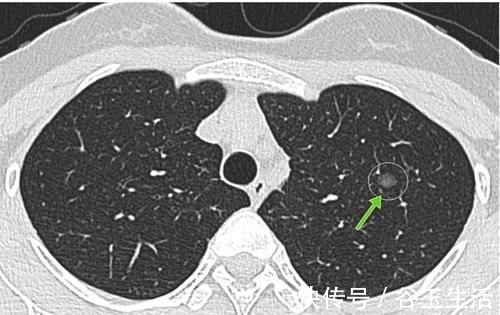 二手烟|肺结节为什么越来越多,发现后怎么办?生活上应该注意什么?