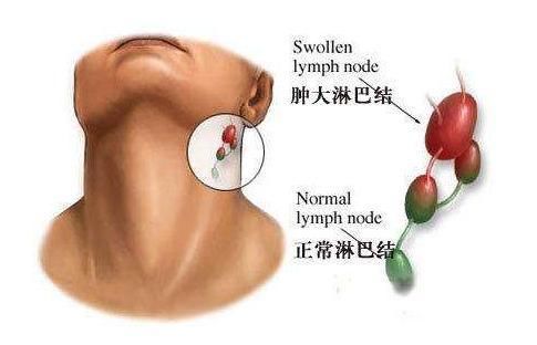  身体出现一些异常表现时，可能是淋巴发炎了，了解一下！