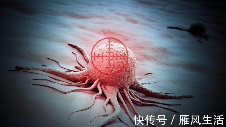 癌症|癌细胞转移、扩散前会有什么症状真心提醒最常见的有3种
