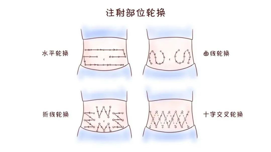 糖尿病|【安全用药】按高风险药品管理的胰岛素，要如何安全使用呢？