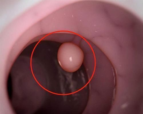 骨质增生|离癌还远的，身上有没有4个“小突起”，占一个也好，你了占几个