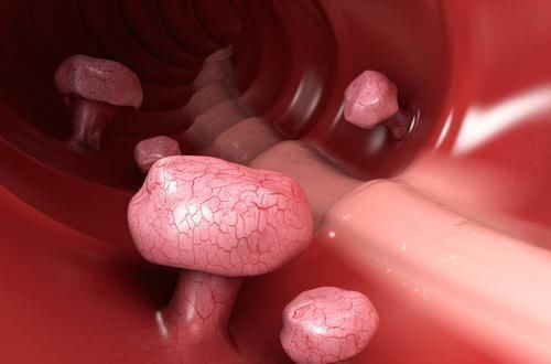 切除|两种息肉一旦发现,最好及时切除,一拖再拖会变成癌症