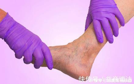 下肢|血管狭窄会有五个“标志”，超过三个以上，“暗示”血栓正在形成