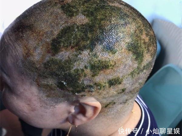 住进|女子爱美染发7小时, 不料操作失败后被剃光头住进了医院