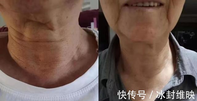 慢性疾病|很多“病”都不算病,就是人老了这4类疾病,或无需过度治疗